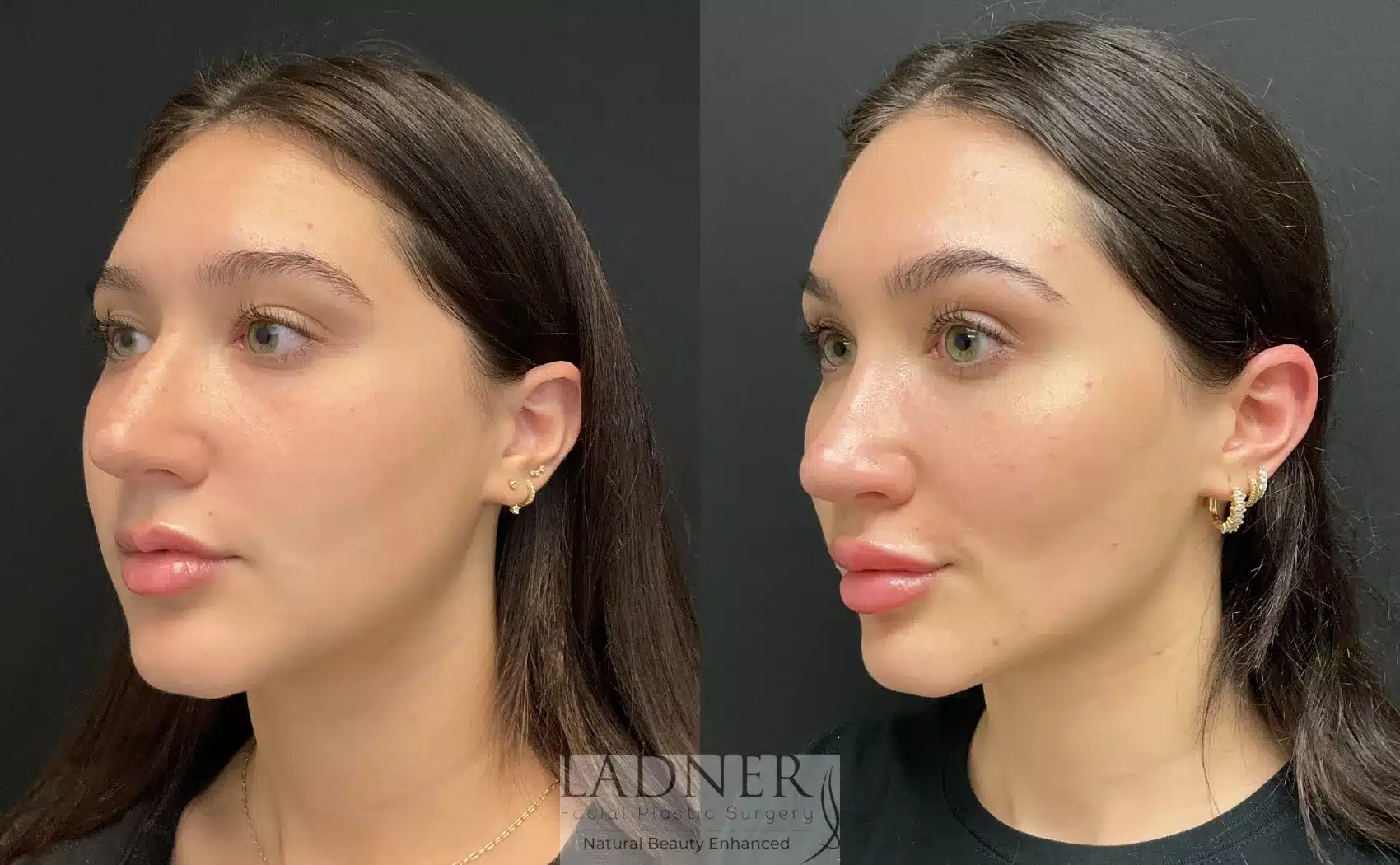 Before and After Image: Rhinoplasty - left-front-oblique