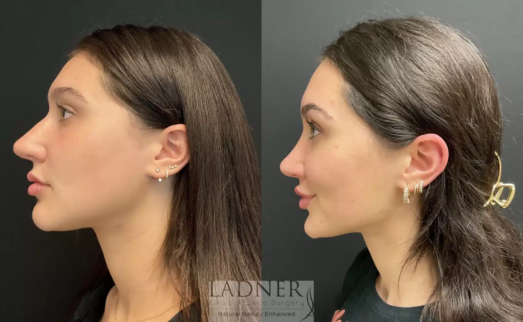 Before and After Image: Rhinoplasty - left-side