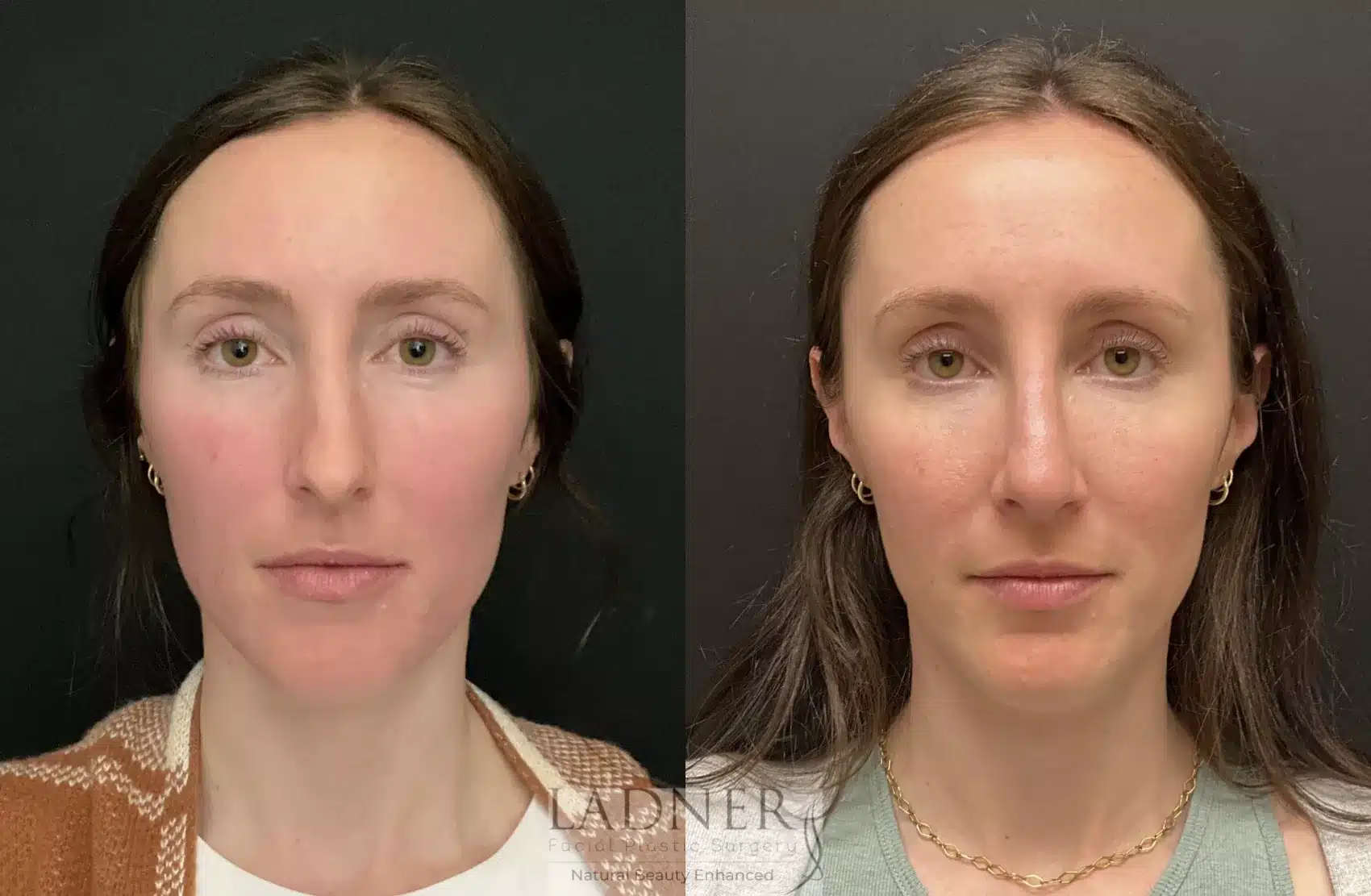 Before and After Image: Rhinoplasty - front