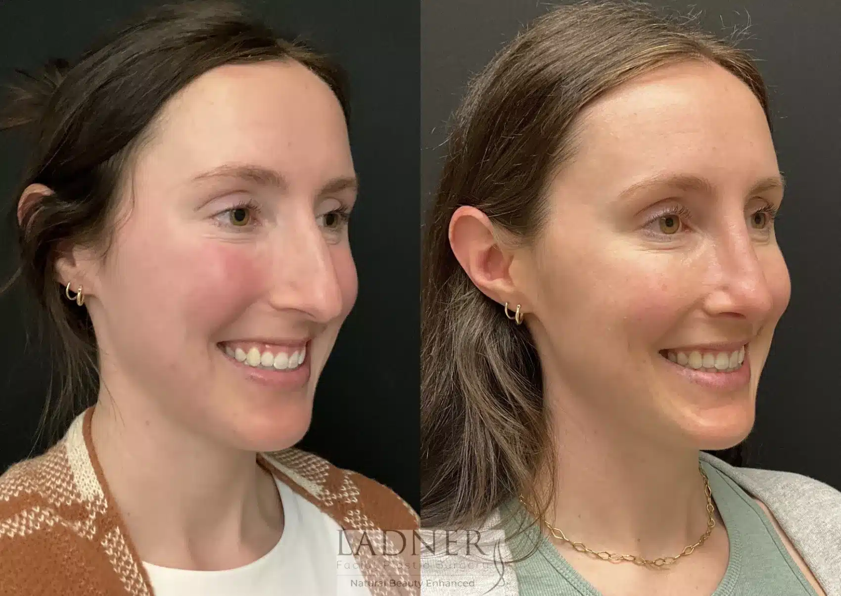 Before and After Image: Rhinoplasty - right-front-oblique