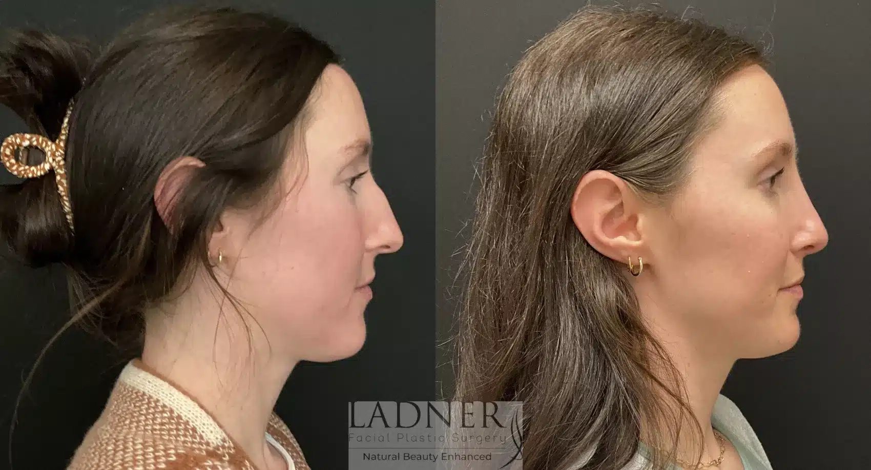 Before and After Image: Rhinoplasty - right-side