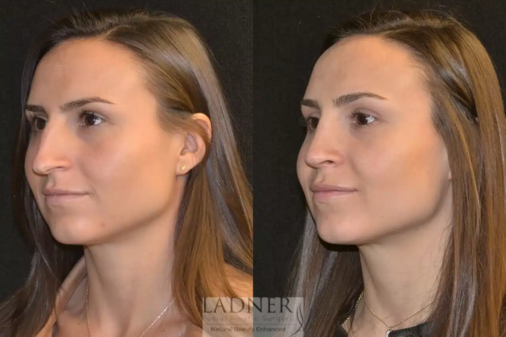 Before and After Image: Rhinoplasty - left-front-oblique