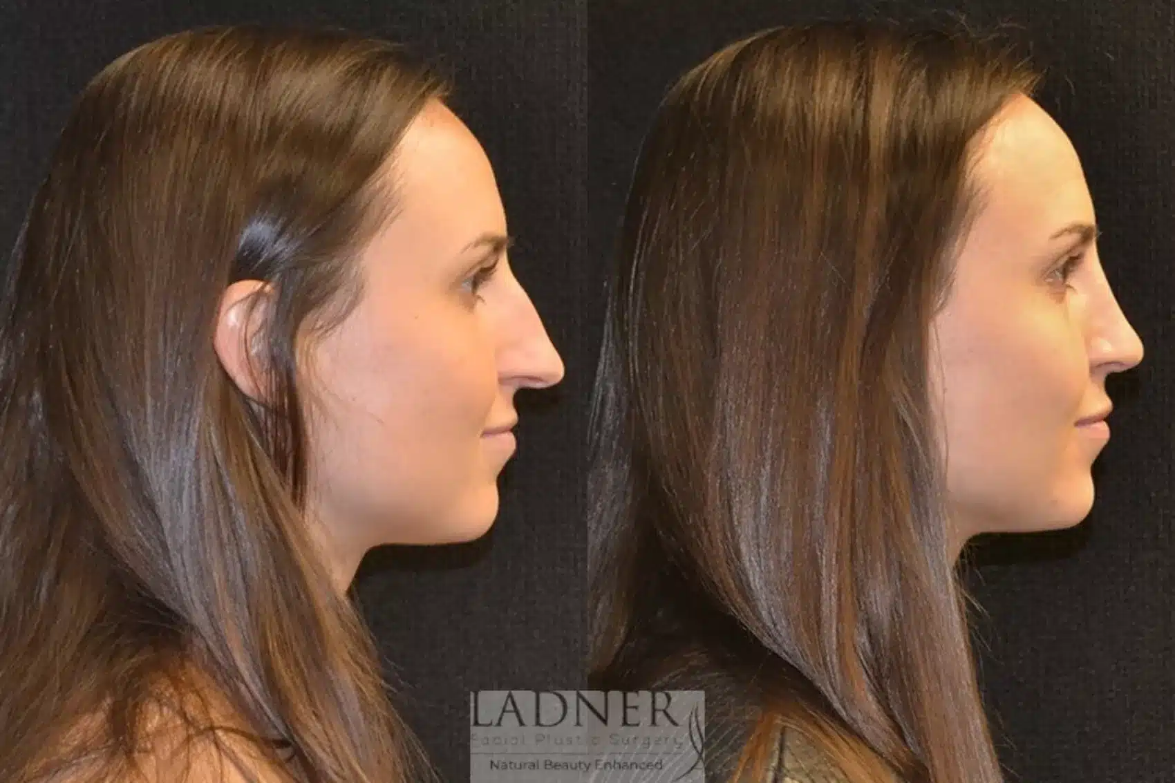 Before and After Image: Rhinoplasty - right-side