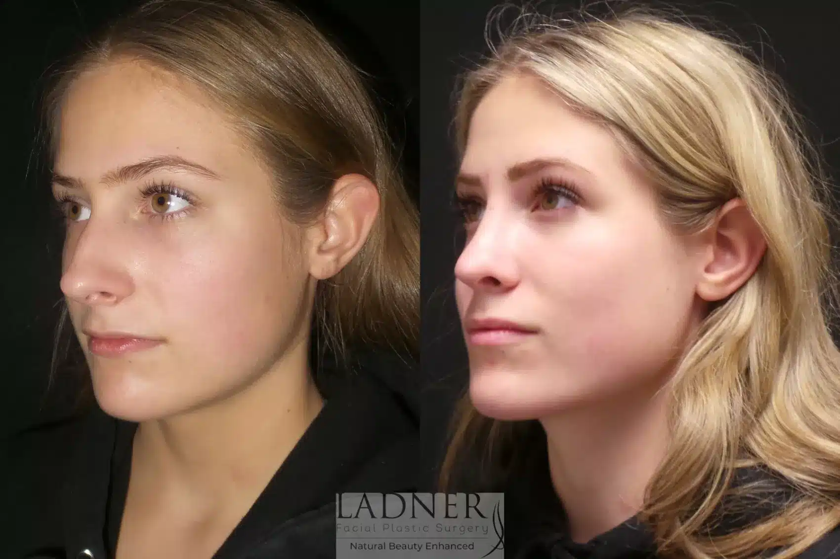 Before and After Image: Rhinoplasty - left-front-oblique