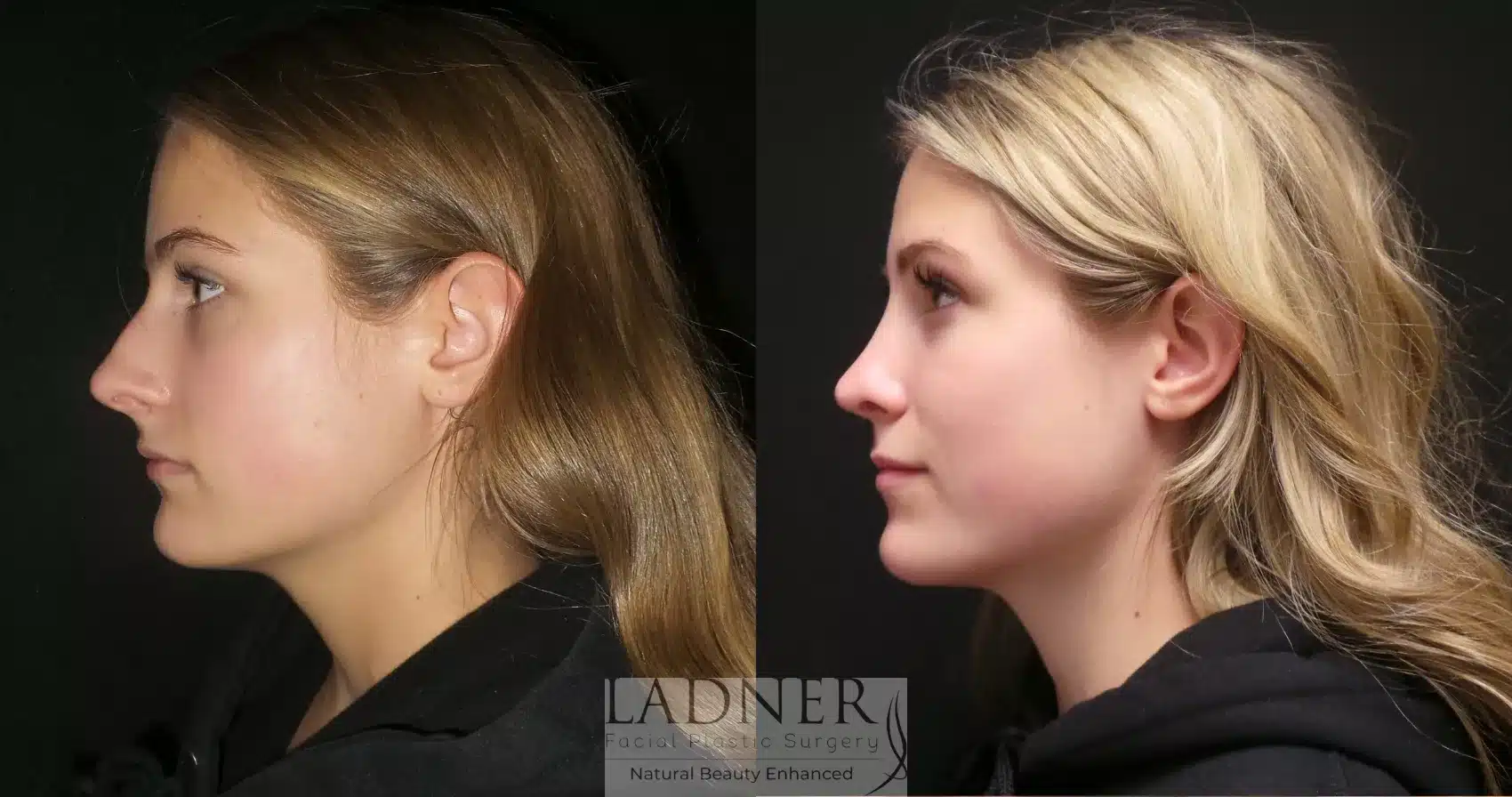 Before and After Image: Rhinoplasty - left-side
