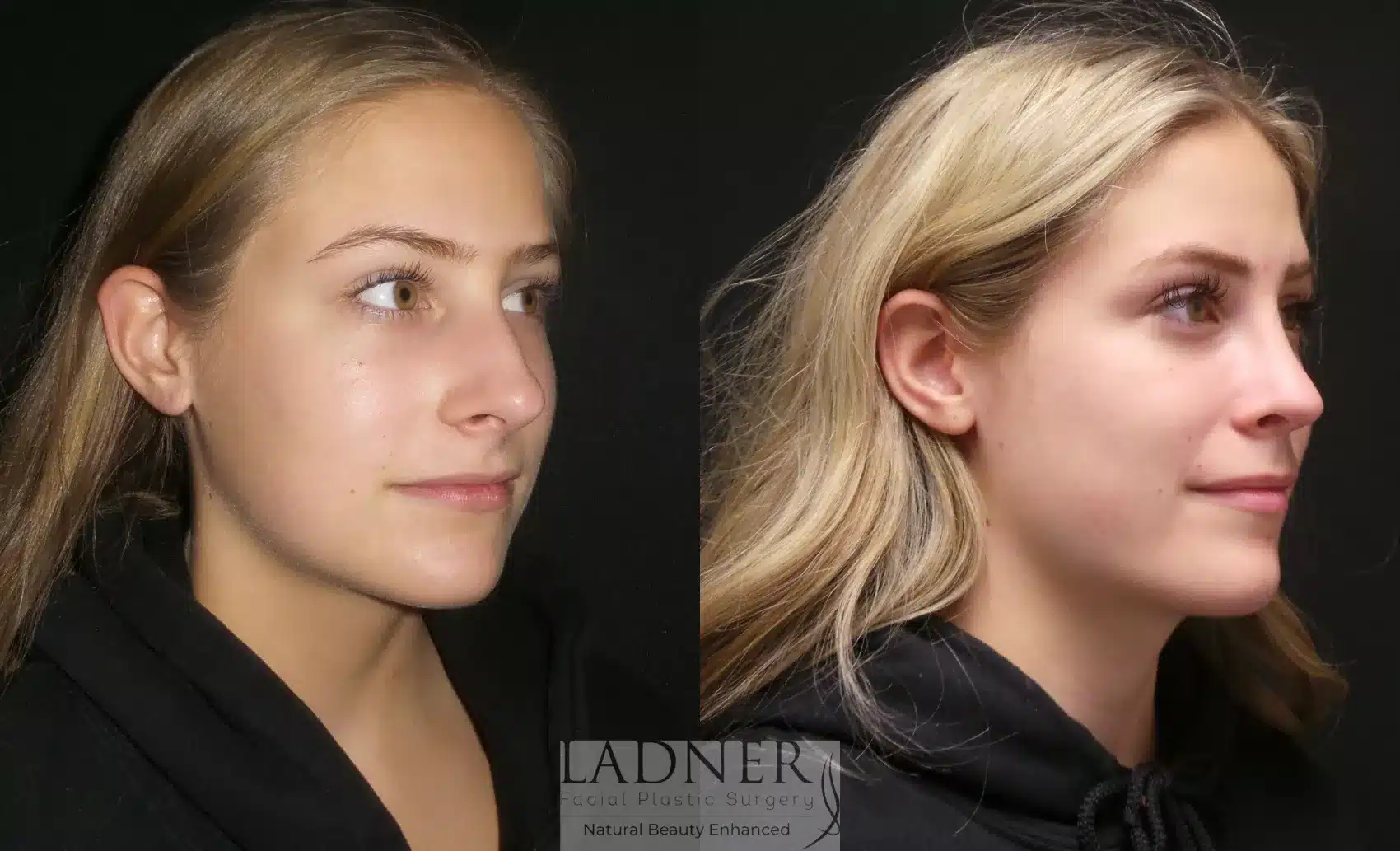 Before and After Image: Rhinoplasty - right-front-oblique