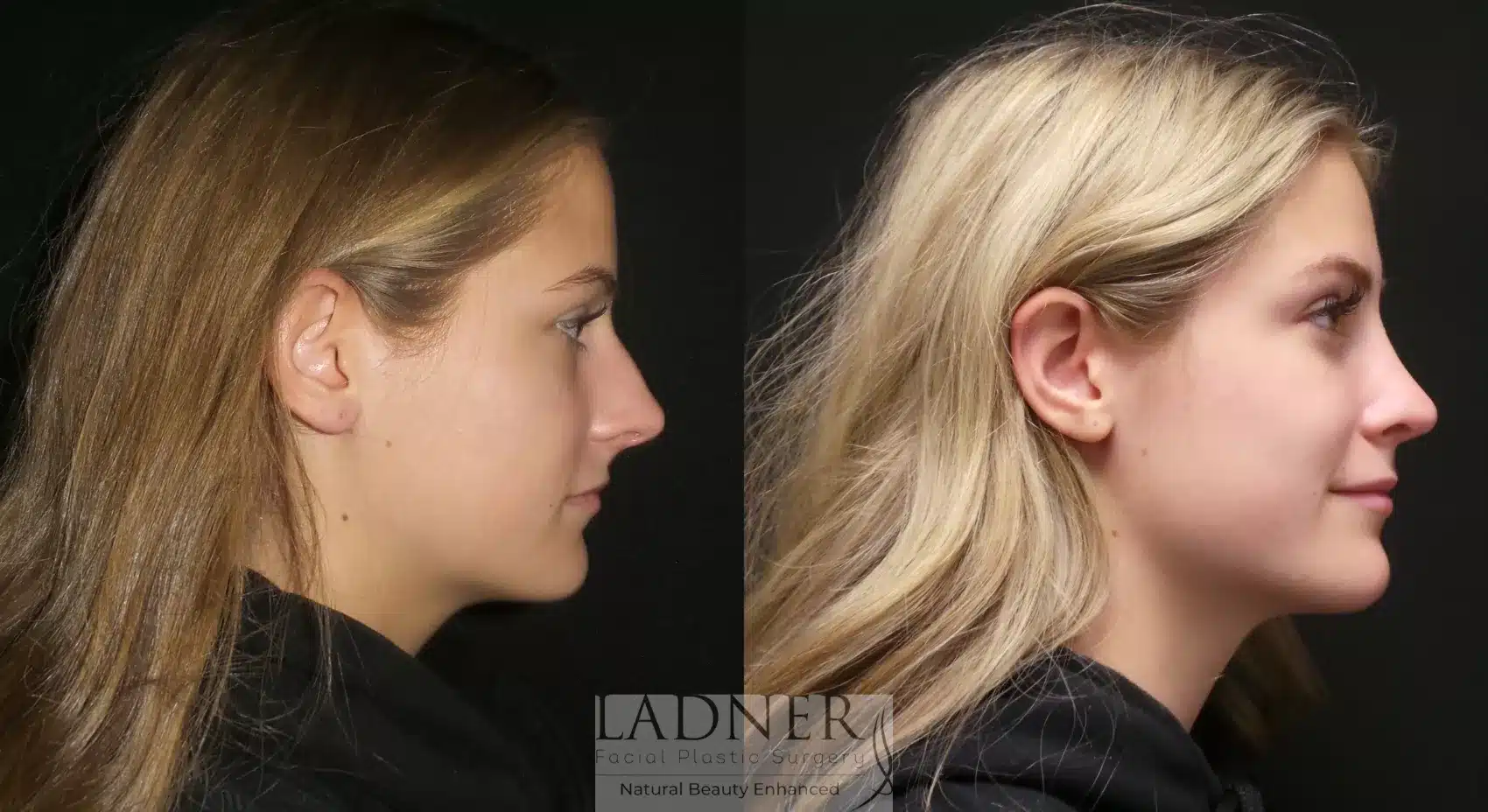 Before and After Image: Rhinoplasty - right-side