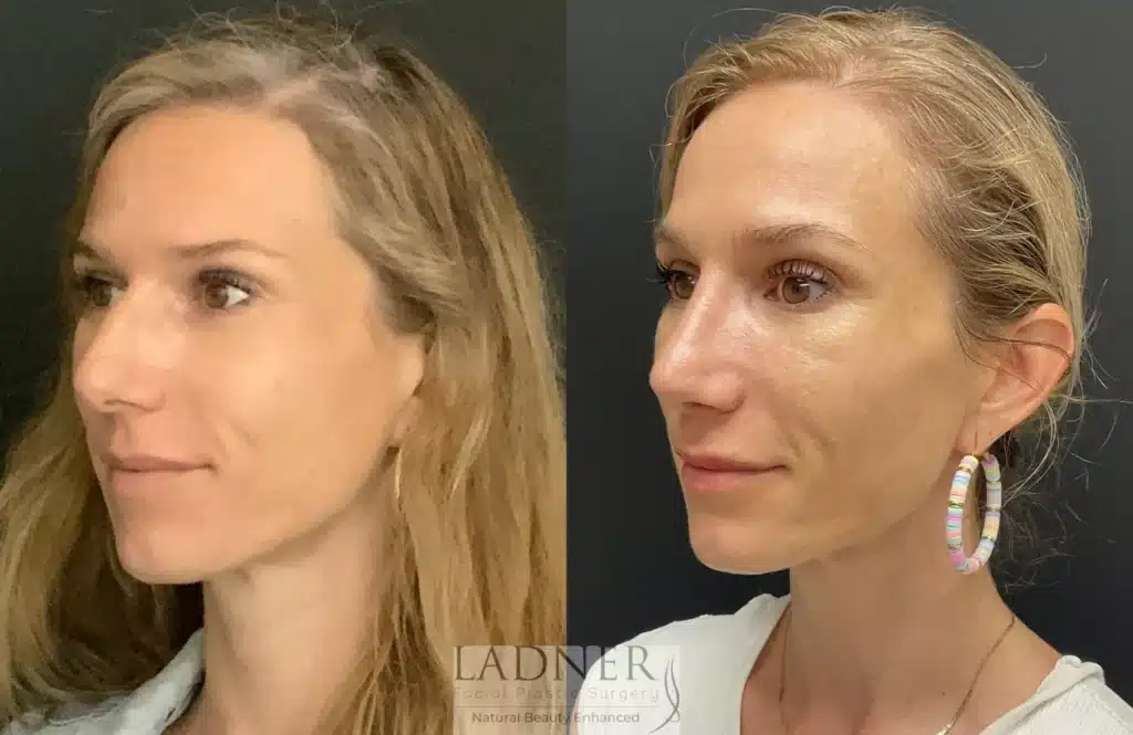 Before and After Image: Rhinoplasty - left-front-oblique