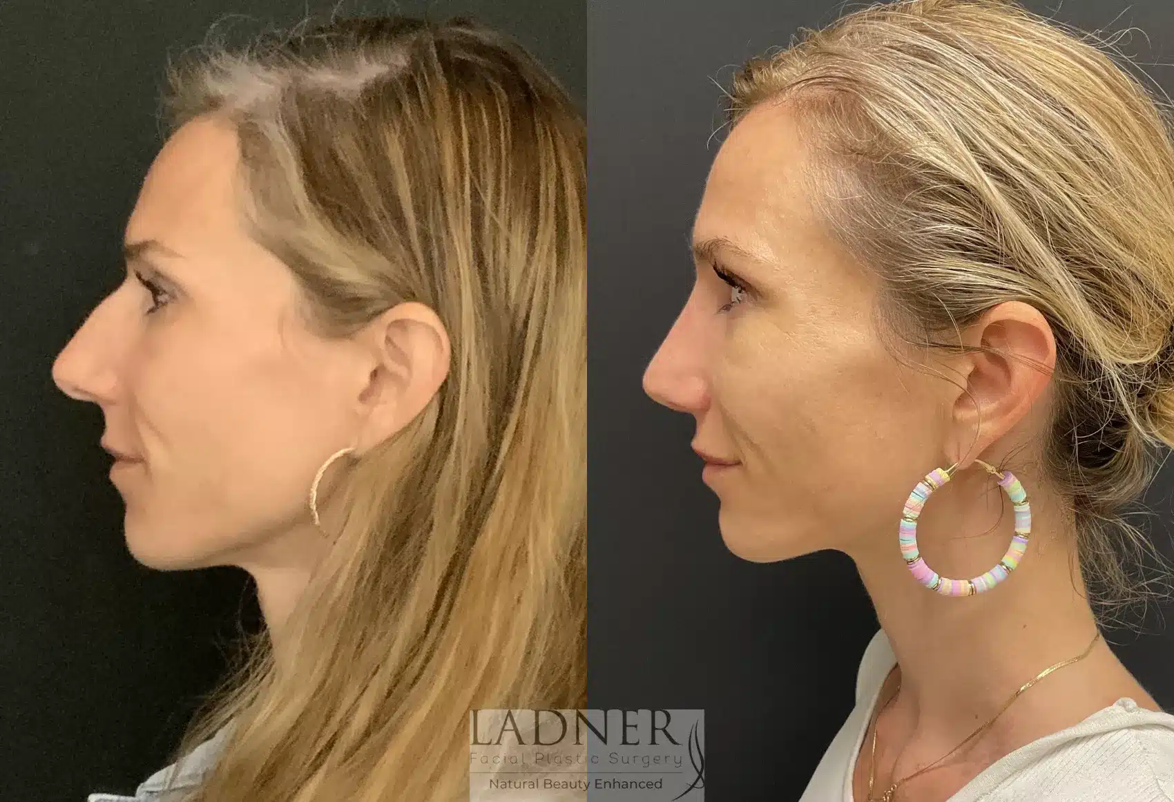 Before and After Image: Rhinoplasty - left-side