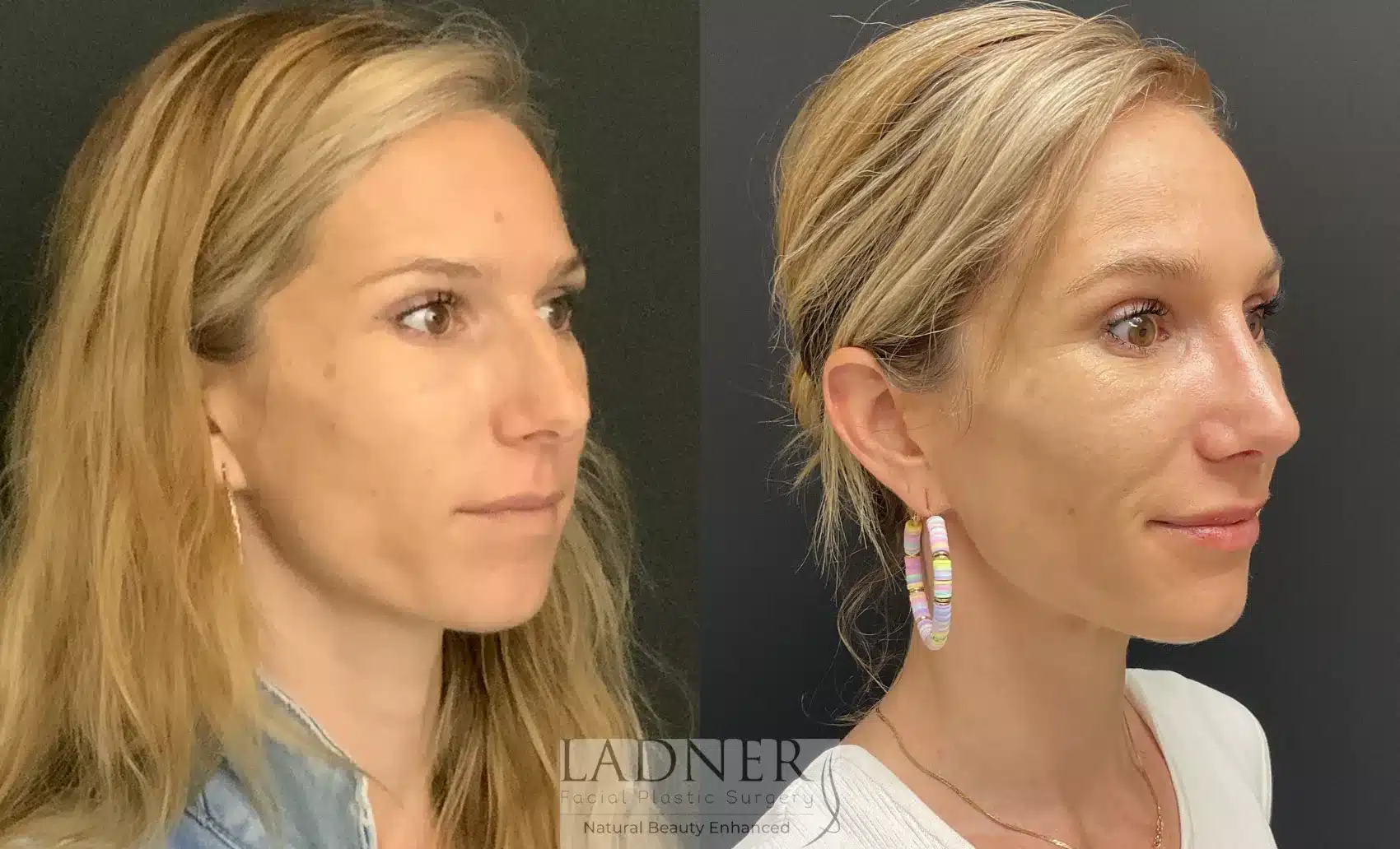 Before and After Image: Rhinoplasty - right-front-oblique