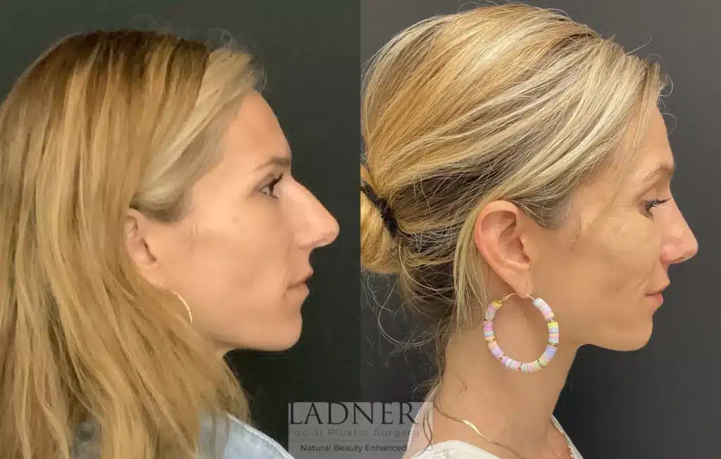 Before and After Image: Rhinoplasty - right-side