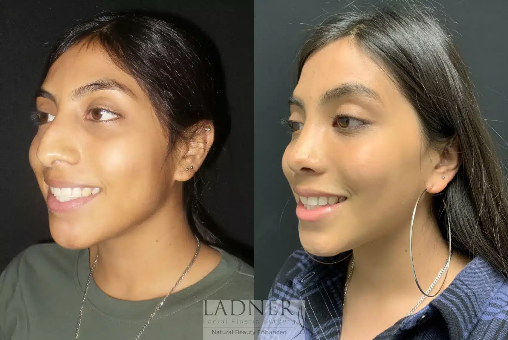 Before and After Image: Rhinoplasty - left-front-oblique