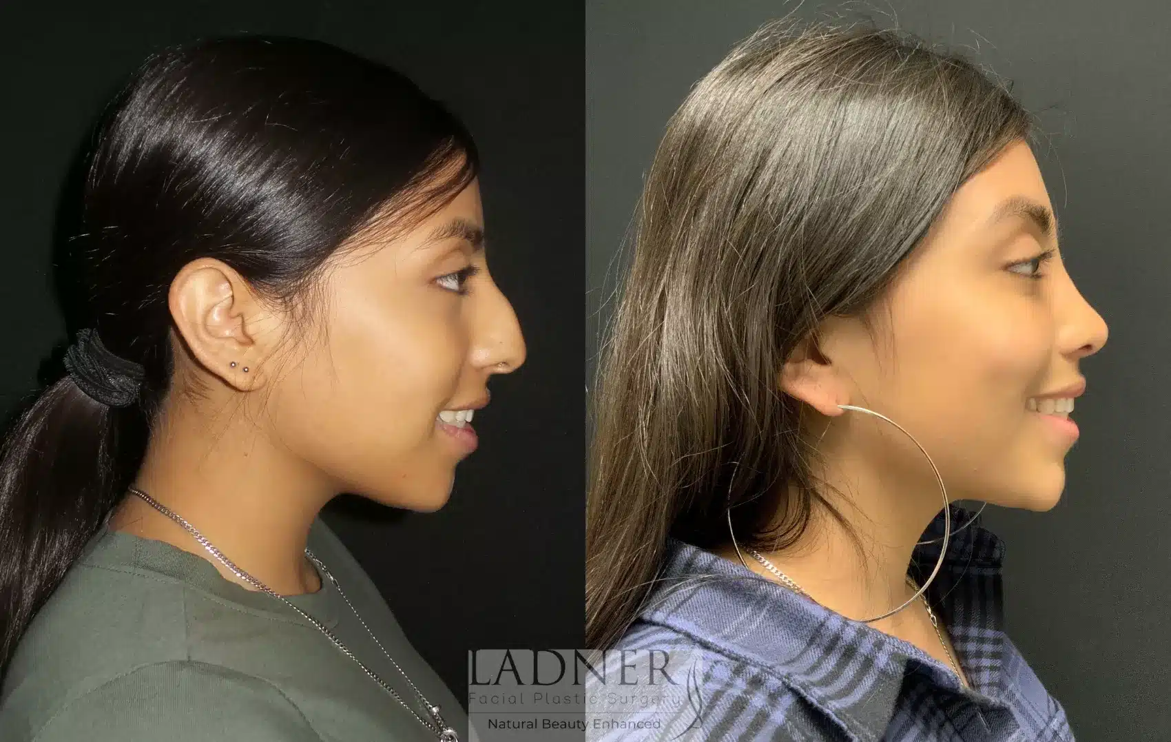 Before and After Image: Rhinoplasty - right-side