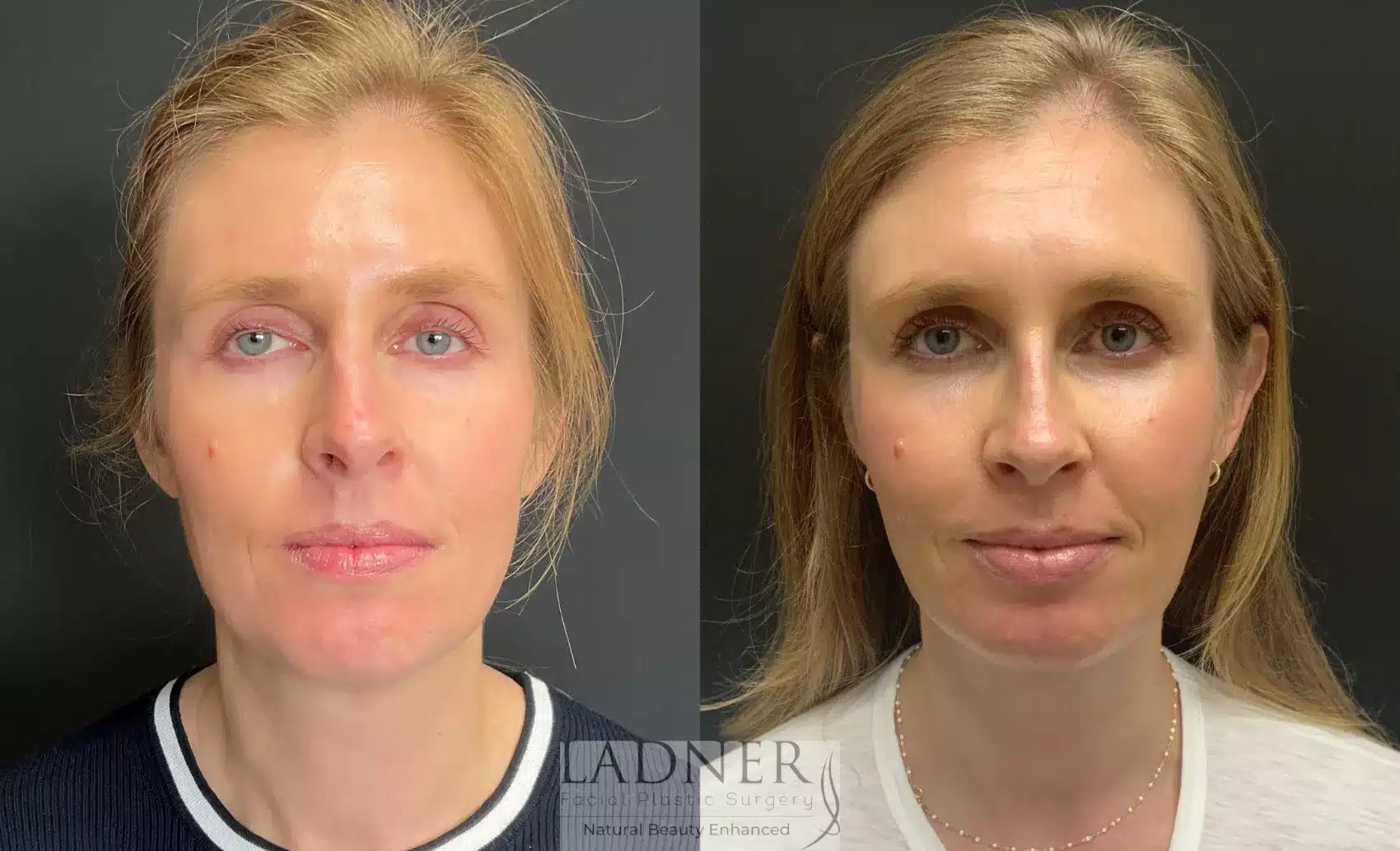 Before and After Image: Rhinoplasty - front