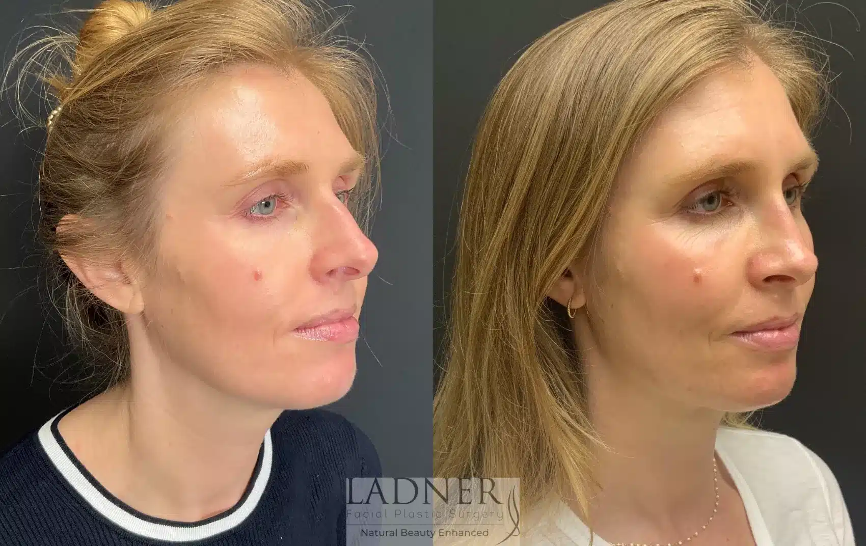 Before and After Image: Rhinoplasty - right-front-oblique