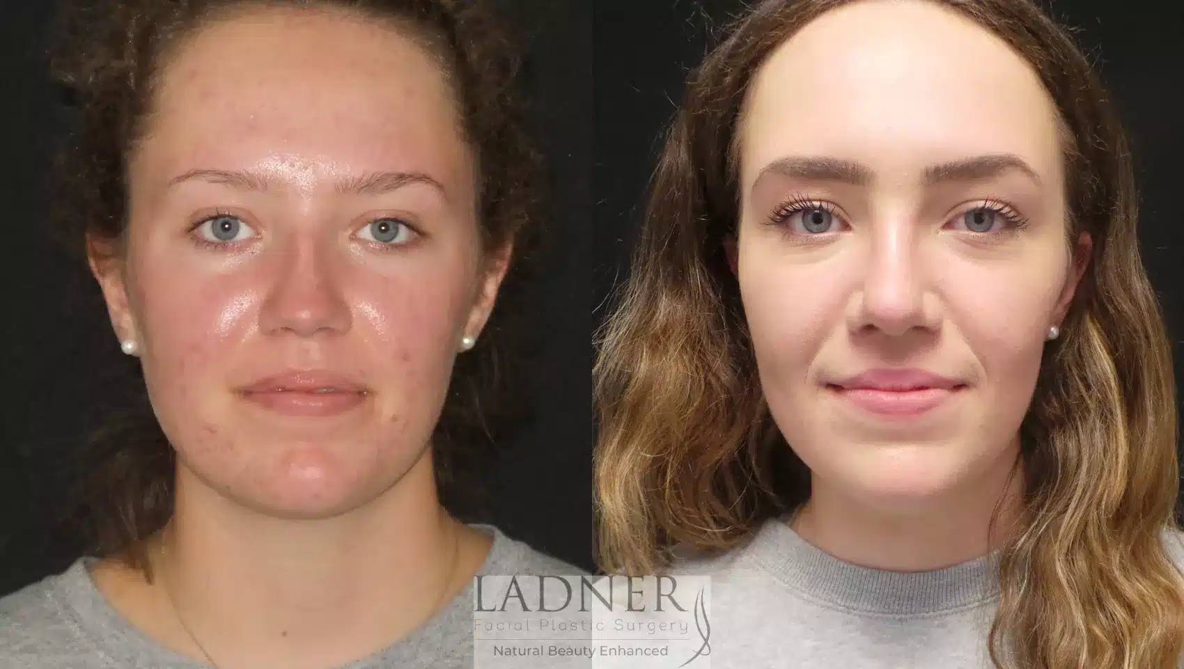 Before and After Image: Rhinoplasty - front