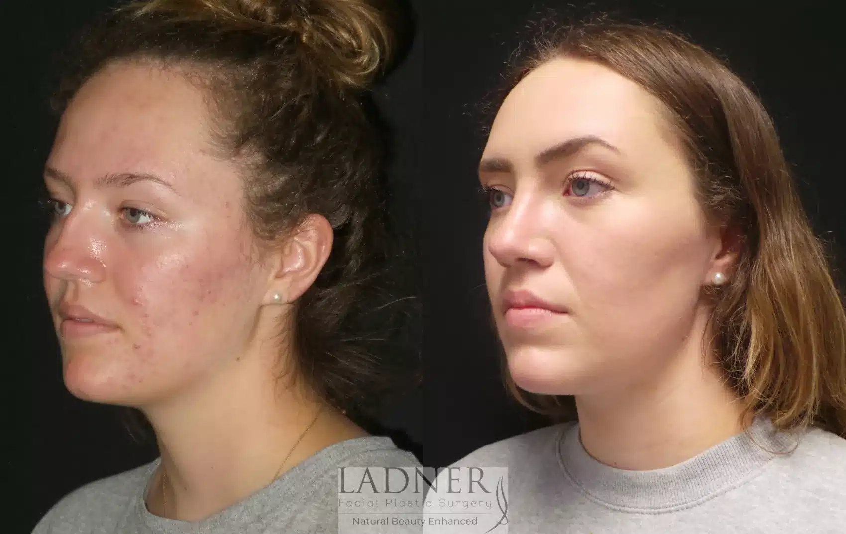 Before and After Image: Rhinoplasty - left-front-oblique