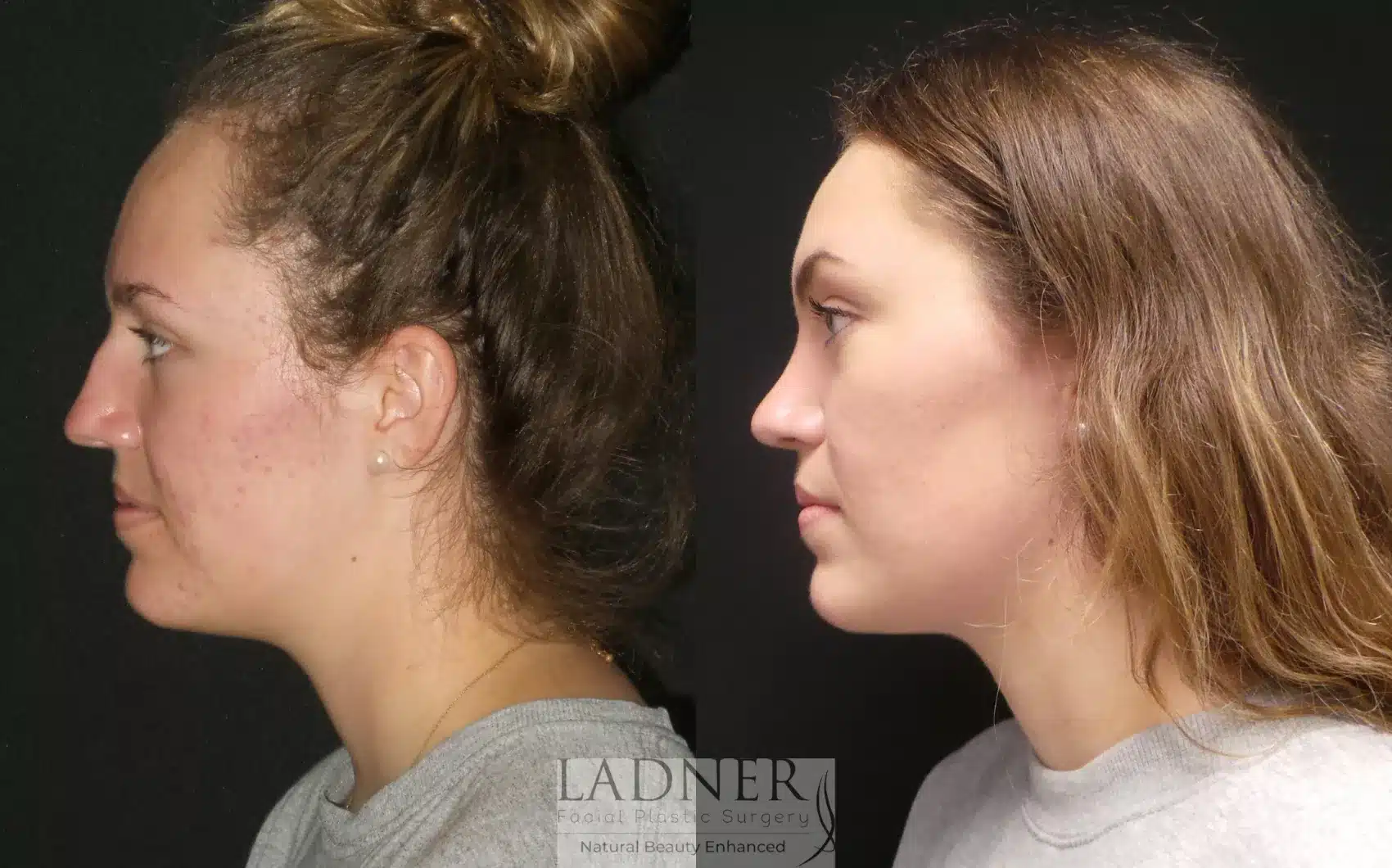 Before and After Image: Rhinoplasty - left-side