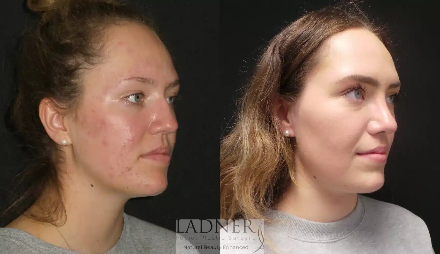 Before and After Image: Rhinoplasty - right-front-oblique