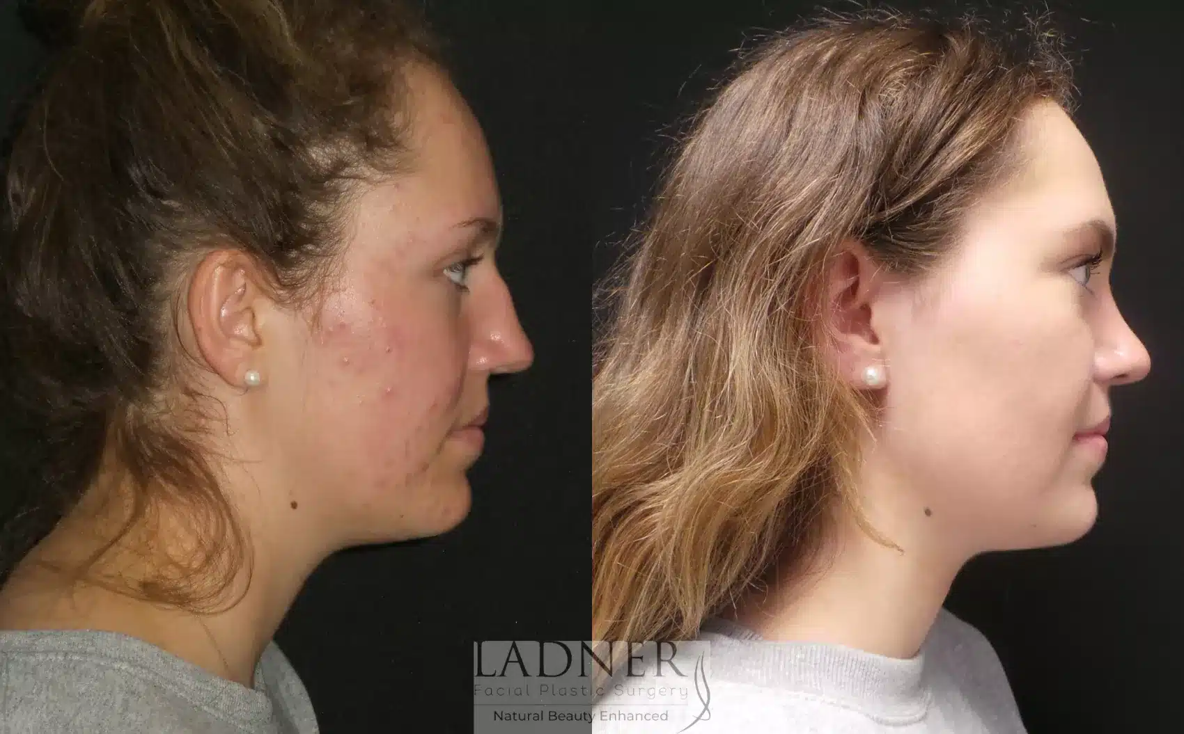 Before and After Image: Rhinoplasty - right-side