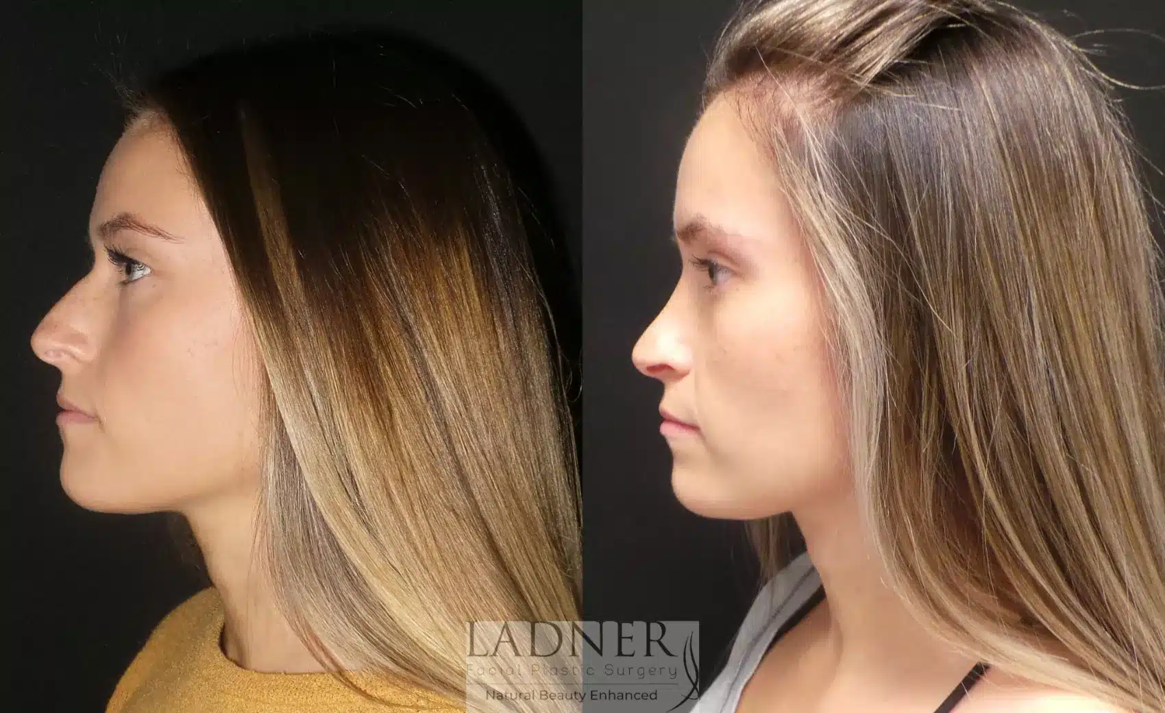 Before and After Image: Rhinoplasty - left-side