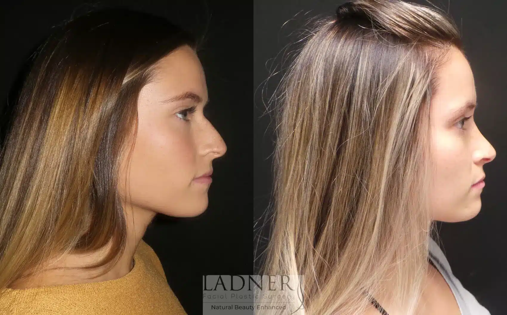 Before and After Image: Rhinoplasty - right-side