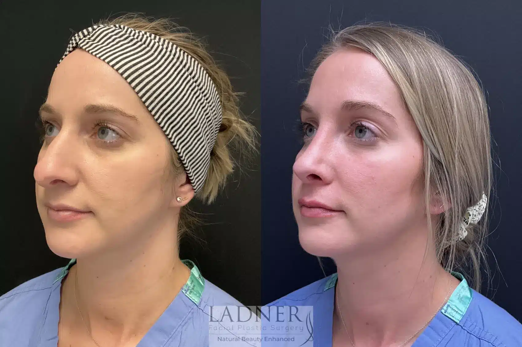 Before and After Image: Rhinoplasty - left-front-oblique