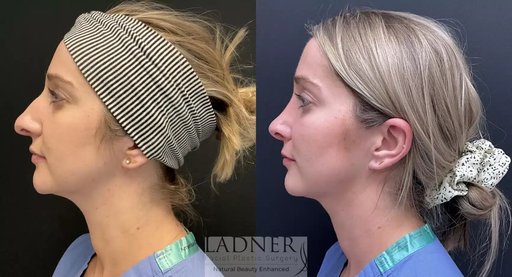 Before and After Image: Rhinoplasty - left-side