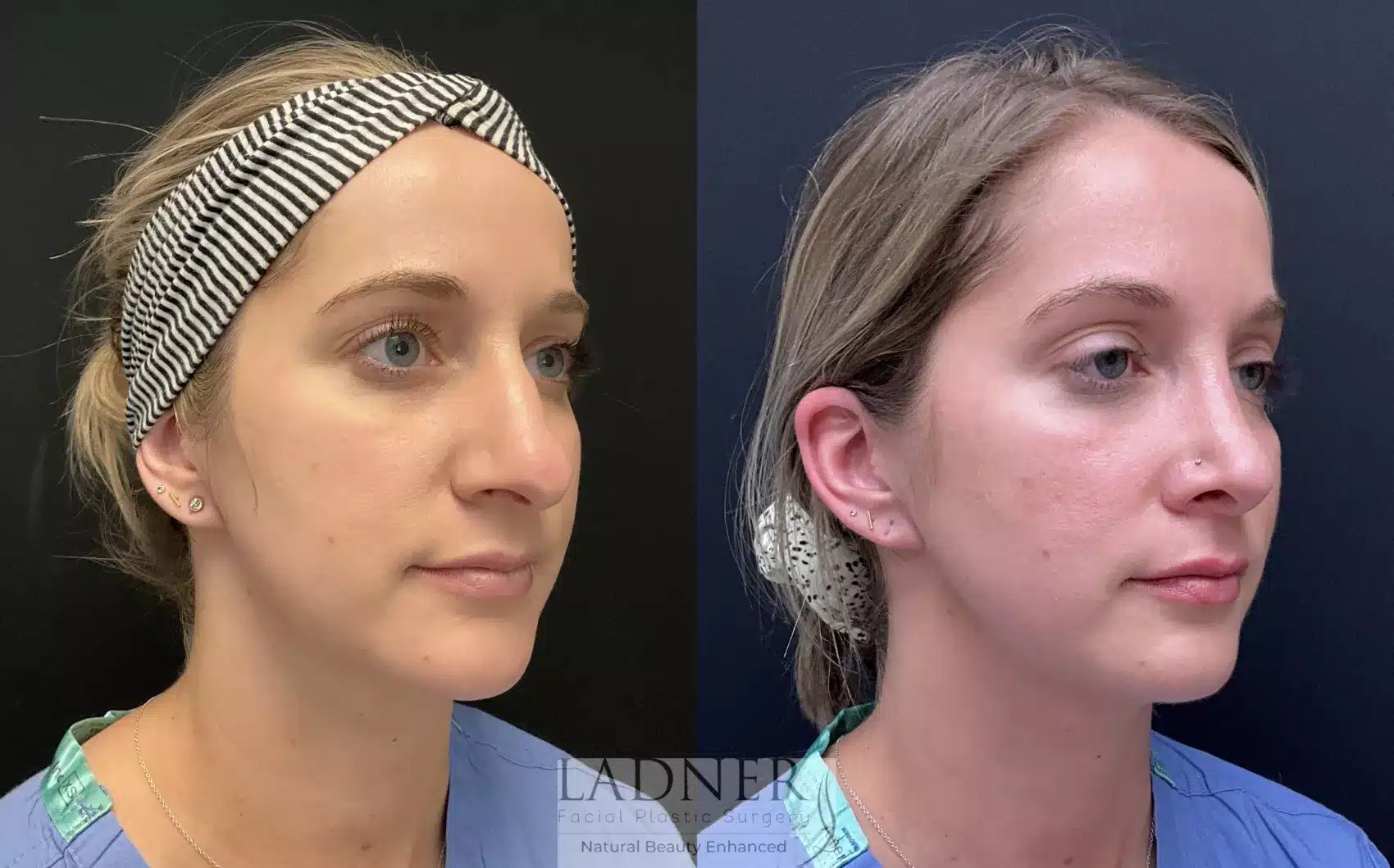 Before and After Image: Rhinoplasty - right-front-oblique