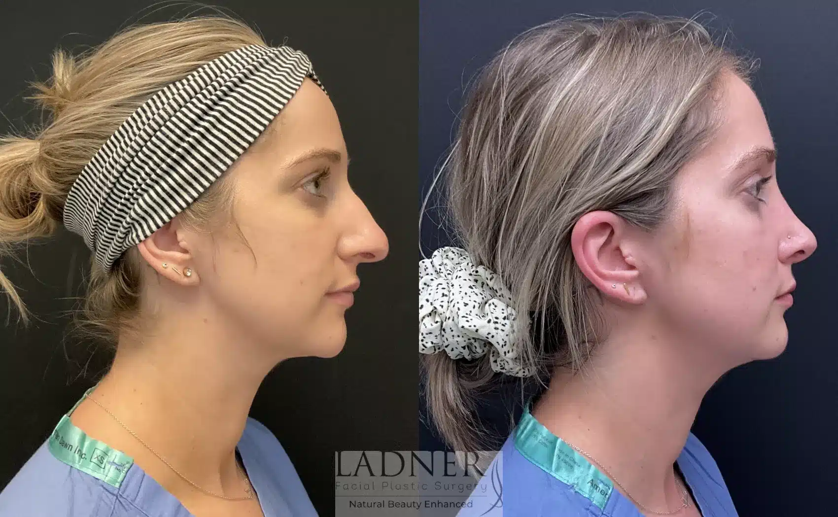 Before and After Image: Rhinoplasty - right-side