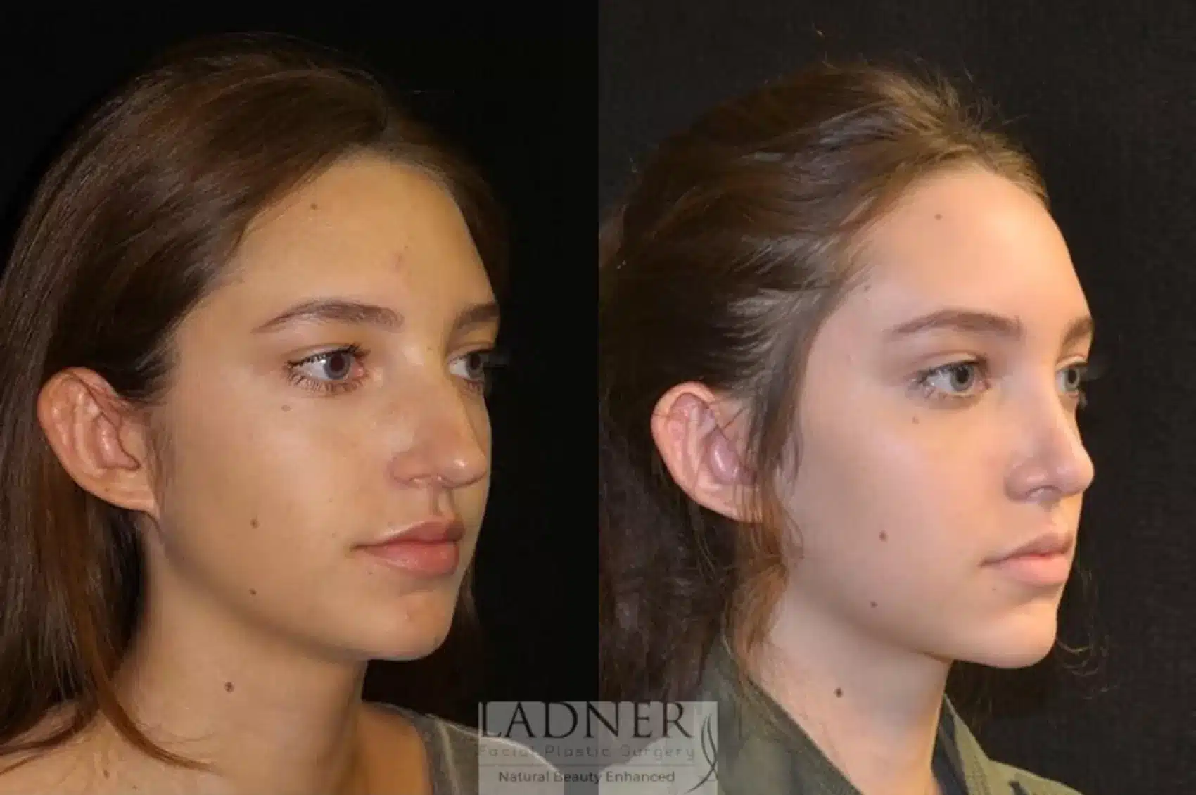 Before and After Image: Rhinoplasty - right-front-oblique