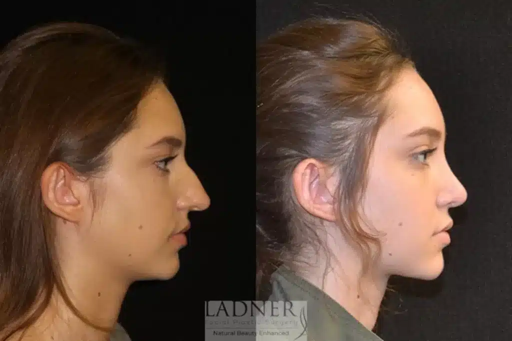 Before and After Image: Rhinoplasty - right-side