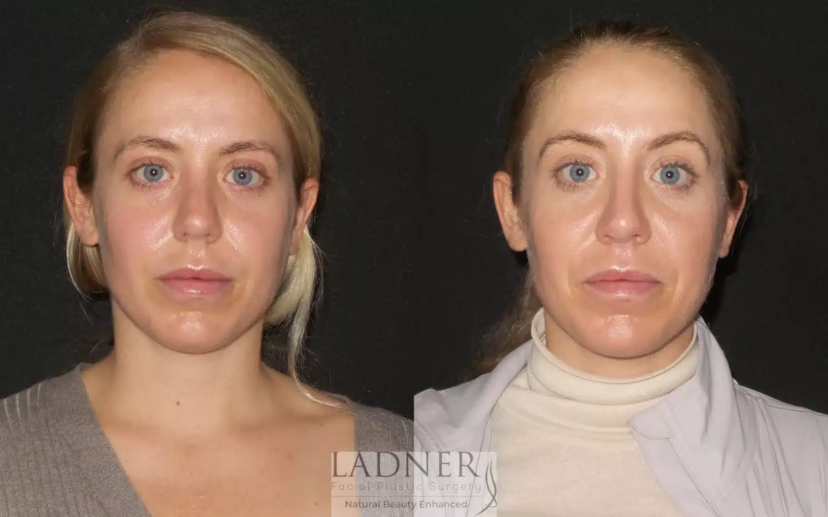 Before and After Image: Rhinoplasty - front