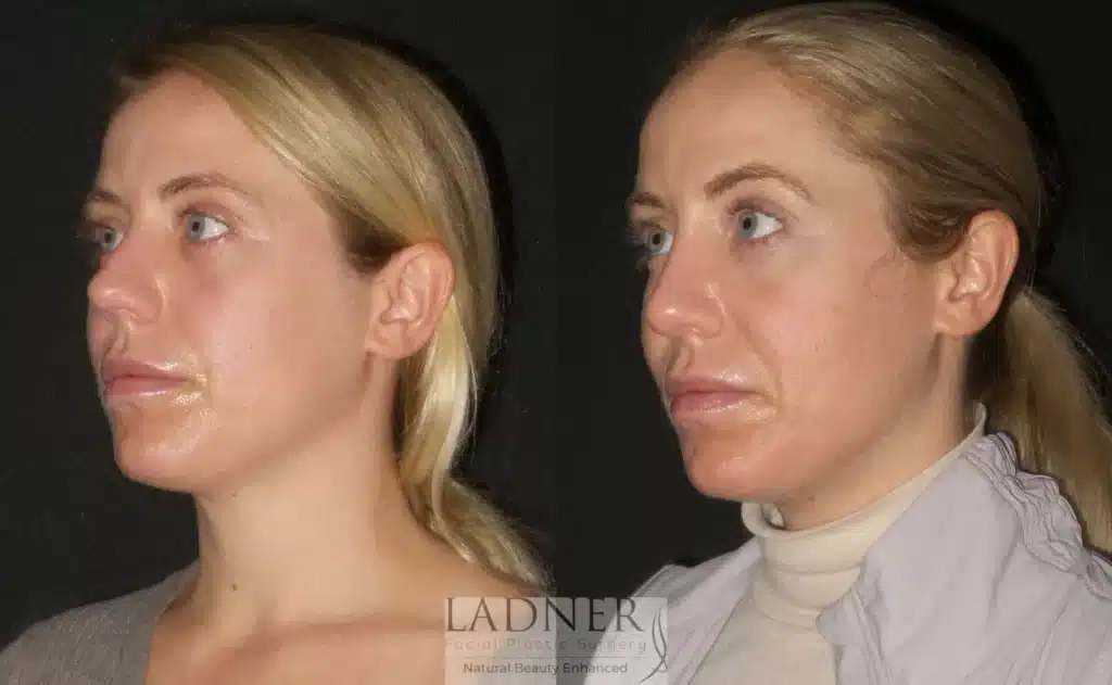 Before and After Image: Rhinoplasty - left-front-oblique