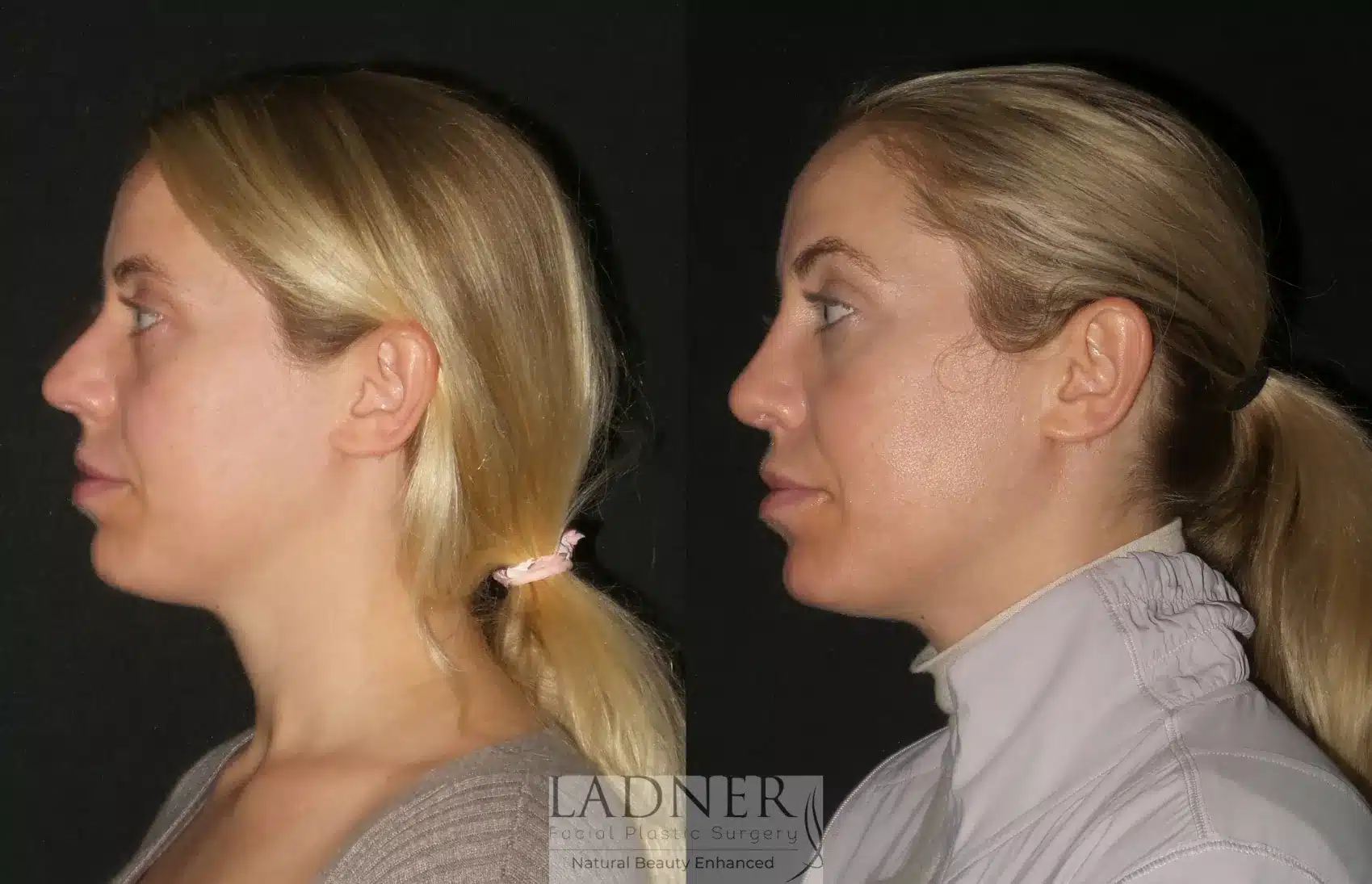 Before and After Image: Rhinoplasty - left-side