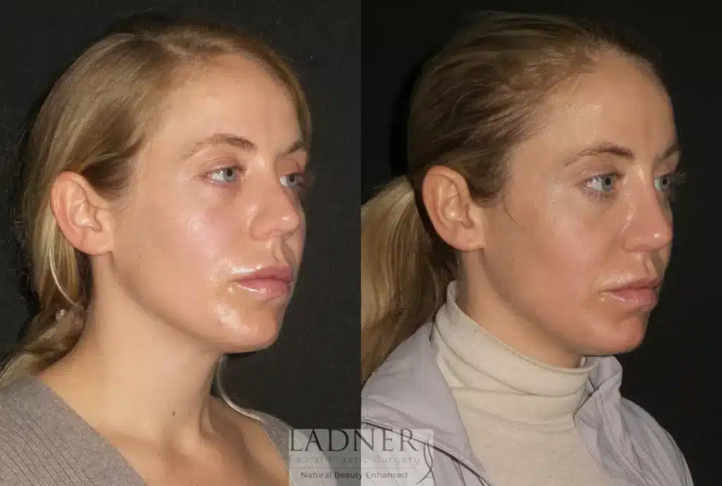 Before and After Image: Rhinoplasty - right-front-oblique