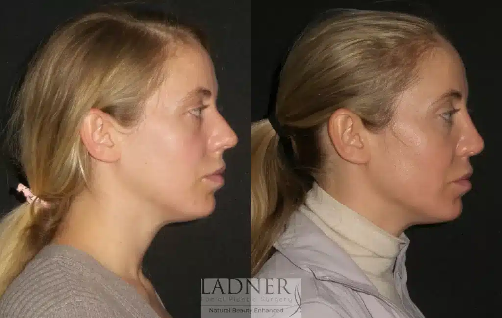 Before and After Image: Rhinoplasty - right-side