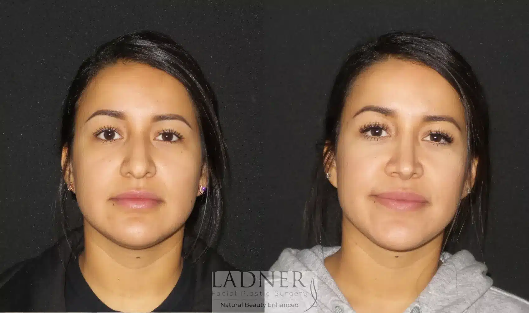 Before and After Image: Rhinoplasty - front