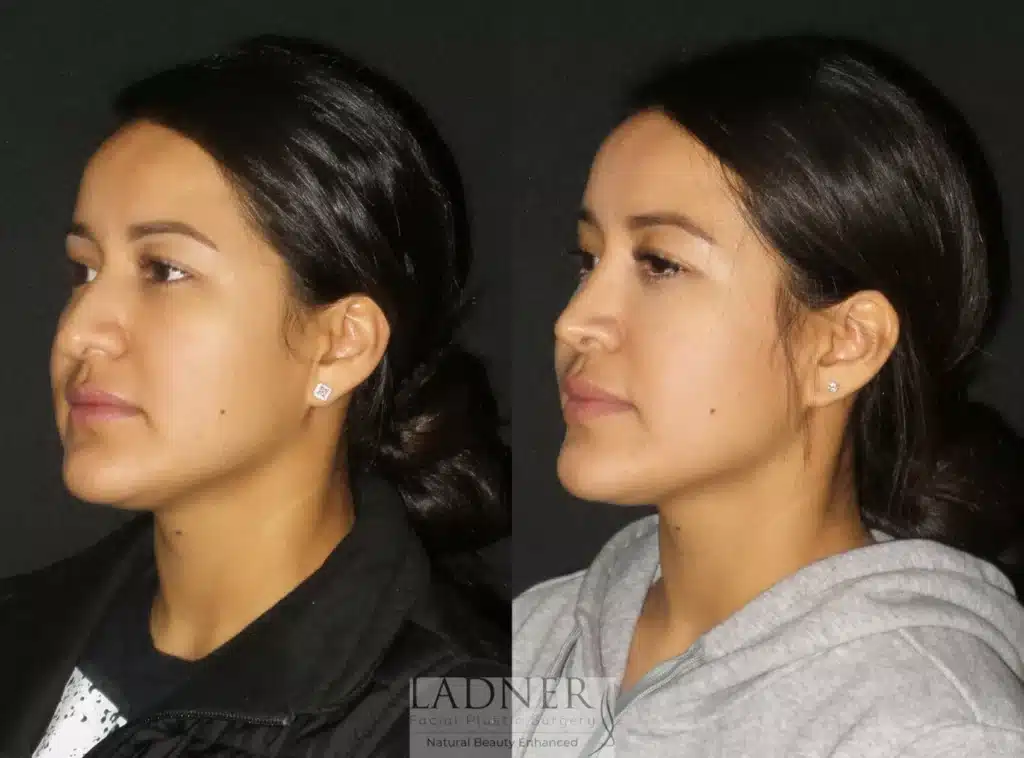 Before and After Image: Rhinoplasty - left-front-oblique