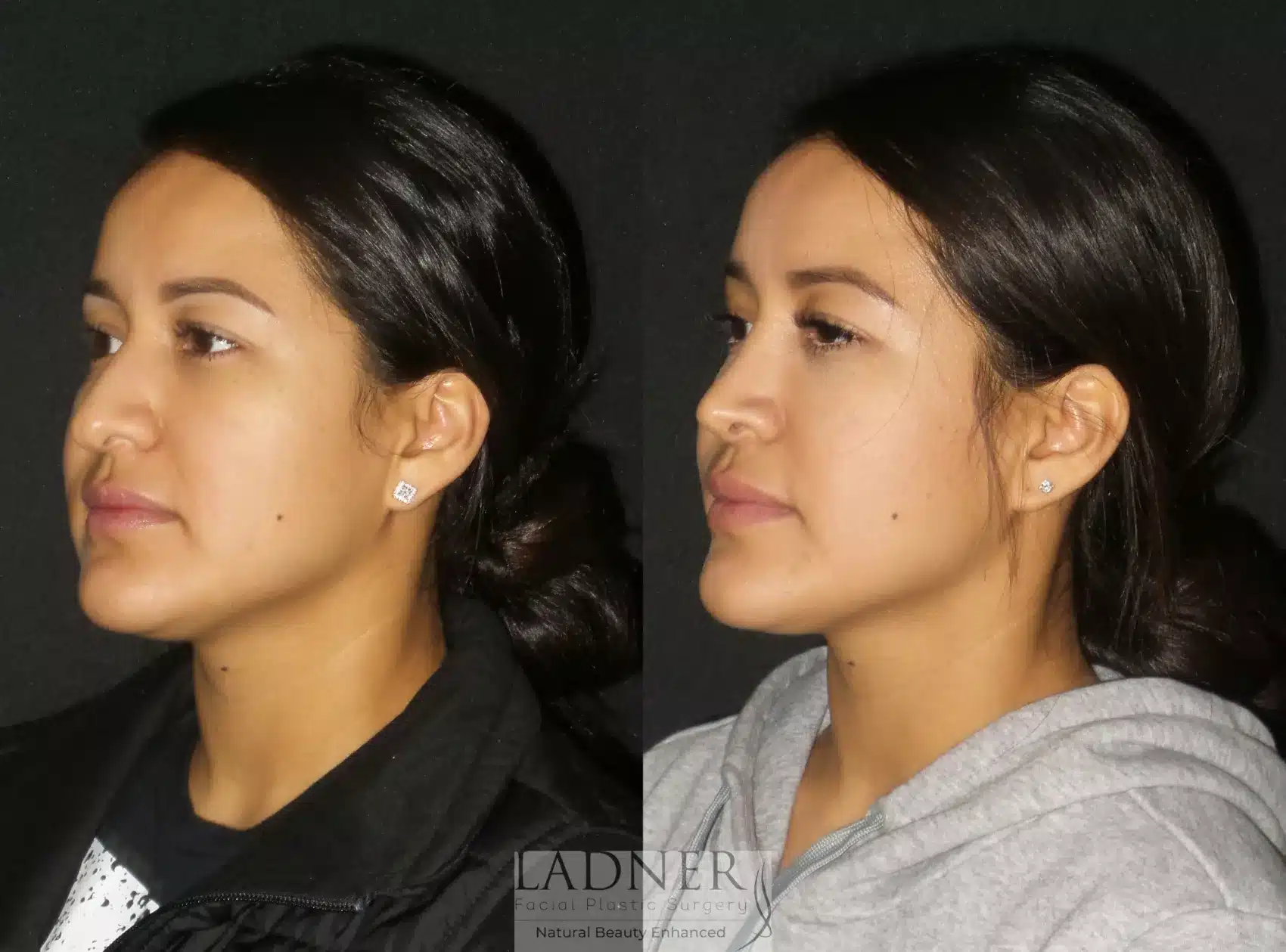 Before and After Image: Rhinoplasty - left-front-oblique