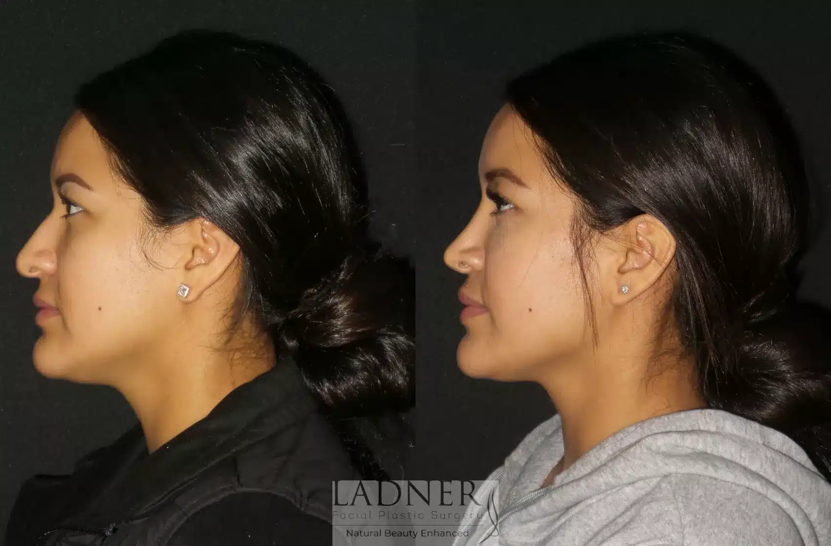 Before and After Image: Rhinoplasty - left-side