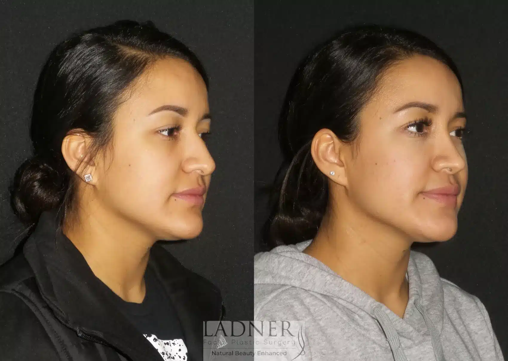 Before and After Image: Rhinoplasty - right-front-oblique