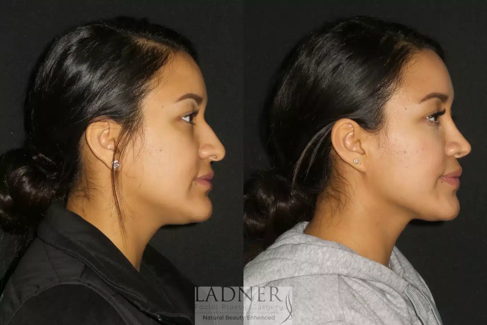Before and After Image: Rhinoplasty - right-side