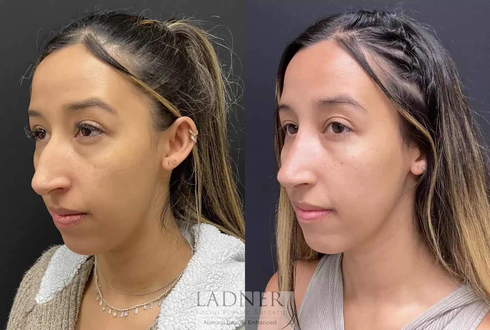 Before and After Image: Rhinoplasty - left-front-oblique