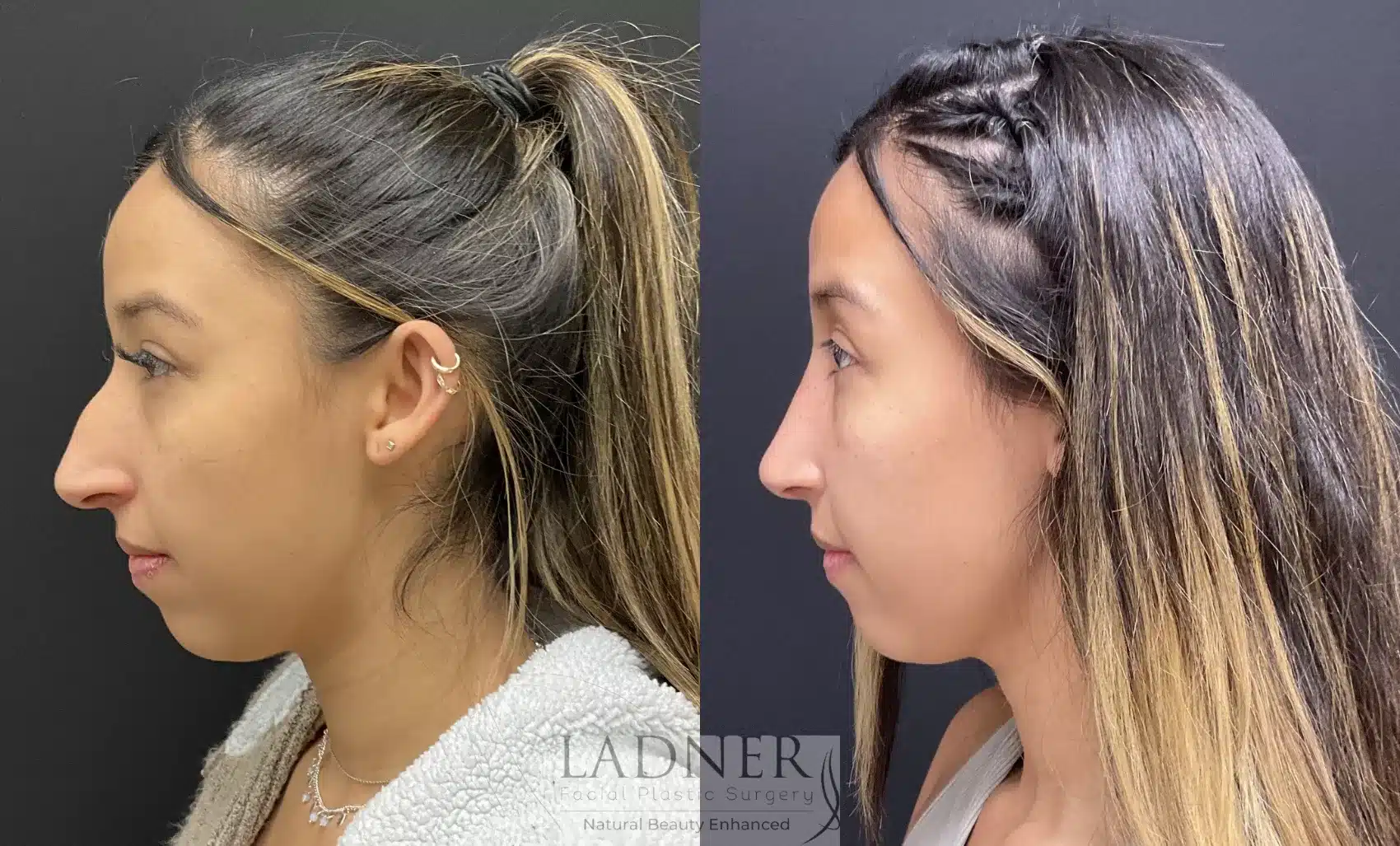 Before and After Image: Rhinoplasty - left-side