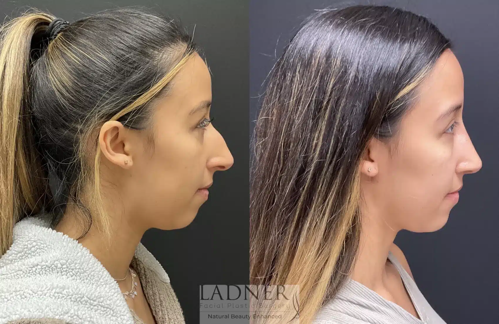 Before and After Image: Rhinoplasty - right-side