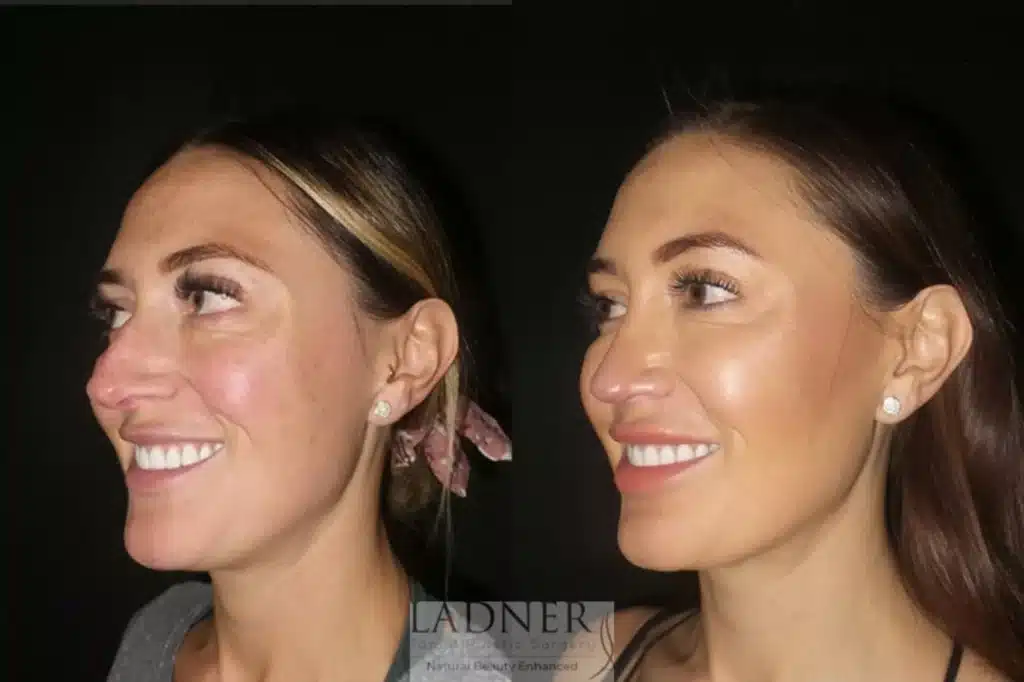 Before and After Image: Rhinoplasty - left-front-oblique