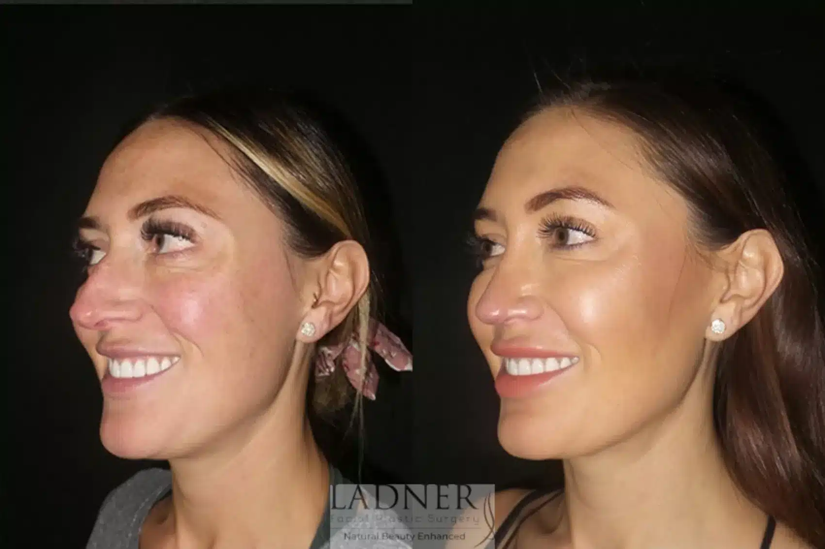 Before and After Image: Rhinoplasty - left-front-oblique