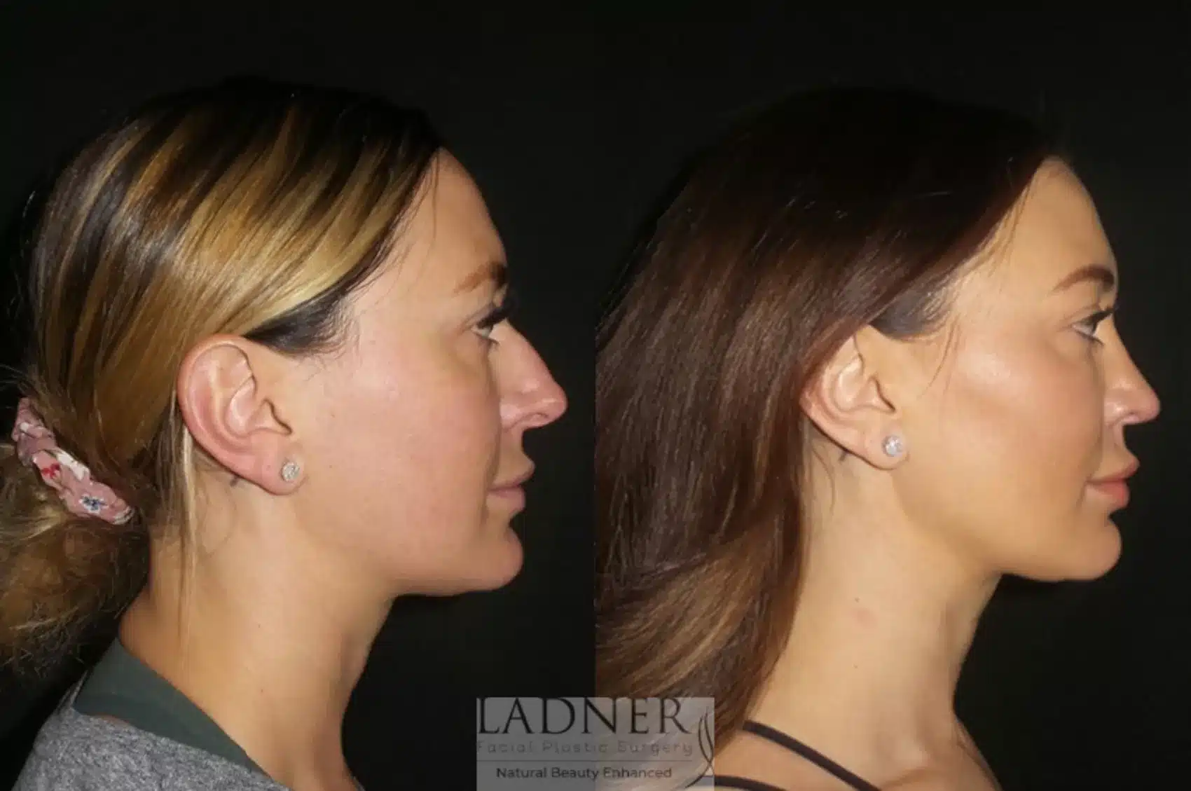 Before and After Image: Rhinoplasty - right-side