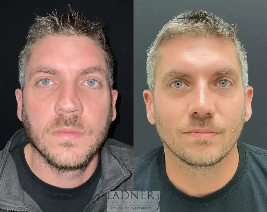 Before and After Image: Rhinoplasty & Facial Plastic Surgery for Men - front